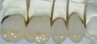 centro-odontostomatologico-coppola-terapia-protesi-denti-001