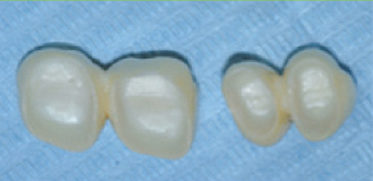 centro-odontostomatologico-coppola-terapia-protesi-denti-002